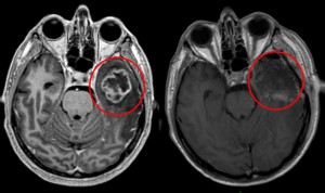 A sinistra immagine di Risonanza magnetica pre-operatoria: il tumore è visibile nel riquadro rosso. A destra una immagine di controllo post-operatoria a 24 ore dall'intervento in cui è evidente l'asportazione macroscopicamente totale del tumore