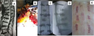 A: crolli vertebrali dorsolombari; B: intervento: le viti ed il cemento vengono inseriti attraverso la pelle; C e D: controllo intraoperatorio finale; E: le piccole incisioni sulla pelle.La paziente, giunta in carrozzina e con alte dosi di morfina, è stata dimessa dopo due giorni. Ad una settimana deambula da sola, senza morfina.