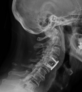 Esempio di stabilizzazione cervicale dopo frattura vertebrale C4C5