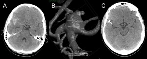 aneurisma TAC angiografia