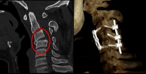 giovane paziente con frattura della quarta vertebra cervicale (C4), con cifosi cervicale post-traumatica (riquadro rosso, foto a sinistra) ed iniziale danno del midollo. A destra il post-operatorio: il paziente è stato sottoposto a corpectomia di C4 e fusione anteriore e posteriore 