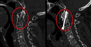 Paziente con frattura della seconda vertebra cervicale (riquadro rosso a sinistra). A destra il post-operatorio