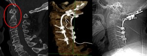 paziente con frattura della seconda vertebra cervicale non guarita dopo collare (riquadro rosso a sinistra). Le immagini al centro (TAC in 3D) ed a destra  (Rx) mostrano il risultato dell'intervento di stabilizzazione occipitocervicale 